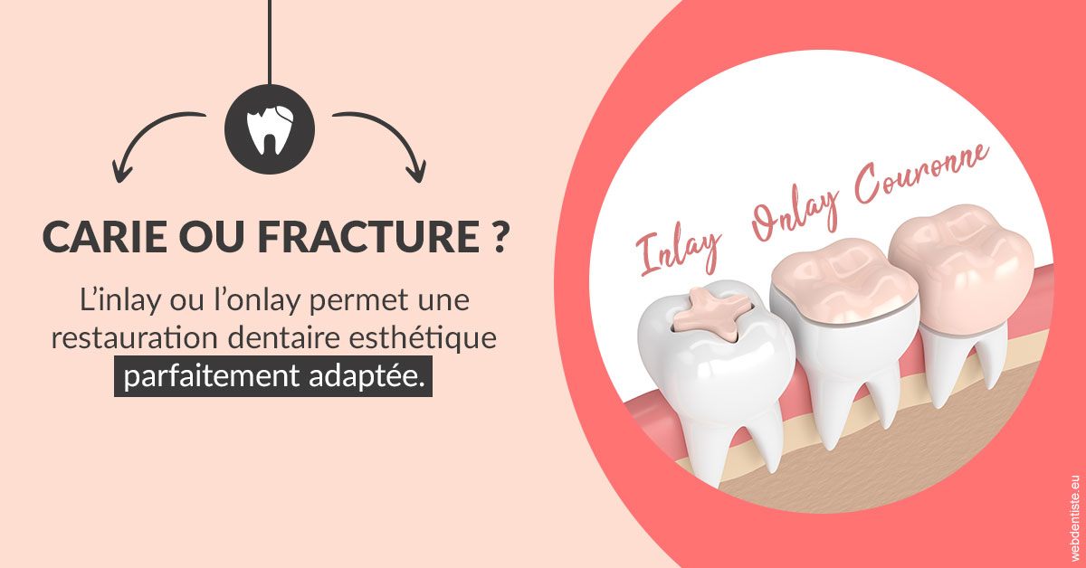 https://dr-elie-kikano.chirurgiens-dentistes.fr/T2 2023 - Carie ou fracture 2