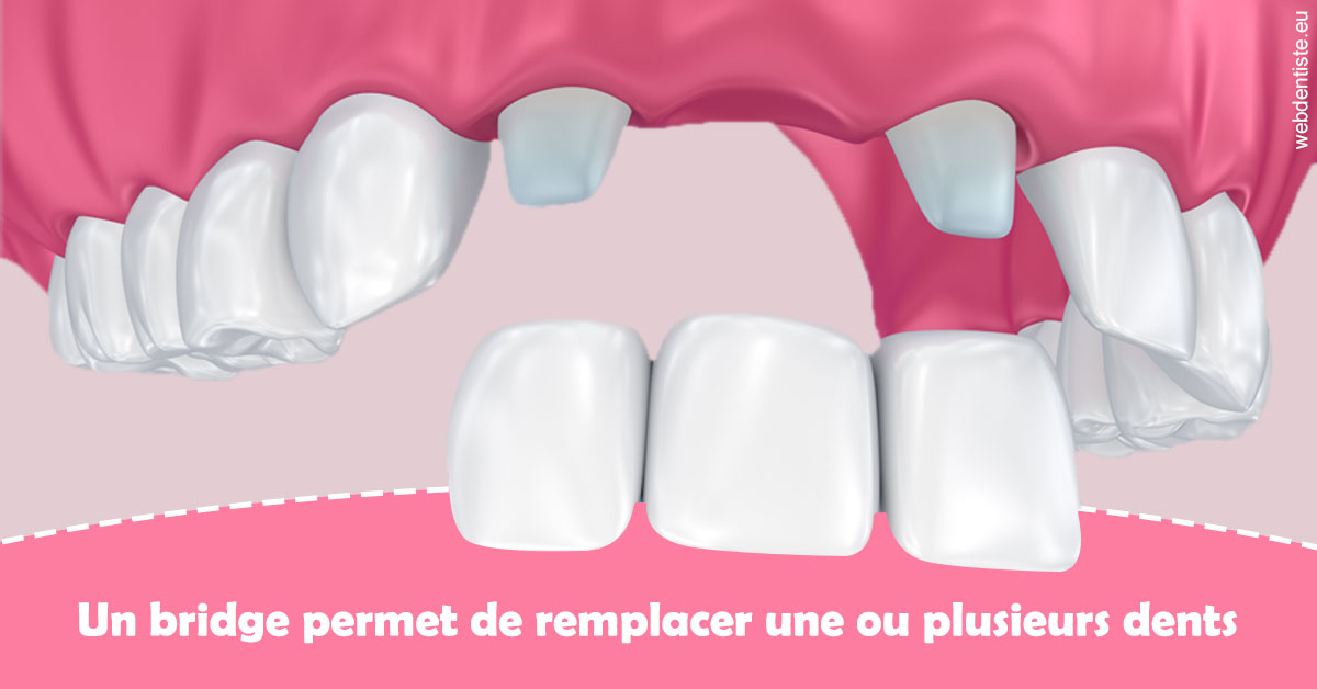 https://dr-elie-kikano.chirurgiens-dentistes.fr/Bridge remplacer dents 2