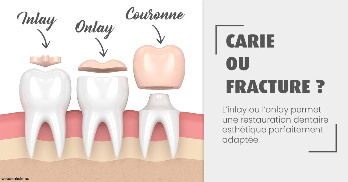 https://dr-elie-kikano.chirurgiens-dentistes.fr/T2 2023 - Carie ou fracture 1