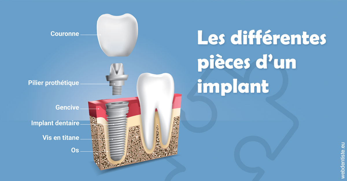 https://dr-elie-kikano.chirurgiens-dentistes.fr/Les différentes pièces d’un implant 1